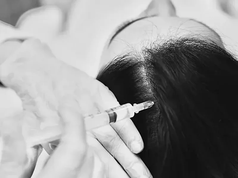 Mesoterapia capilar: frená la caída del pelo