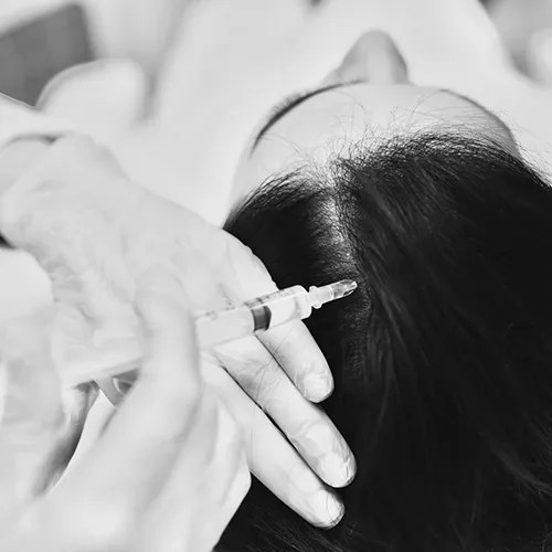 Tratamiento de mesoterapia capilar para la caída del pelo en Spa Belgrano