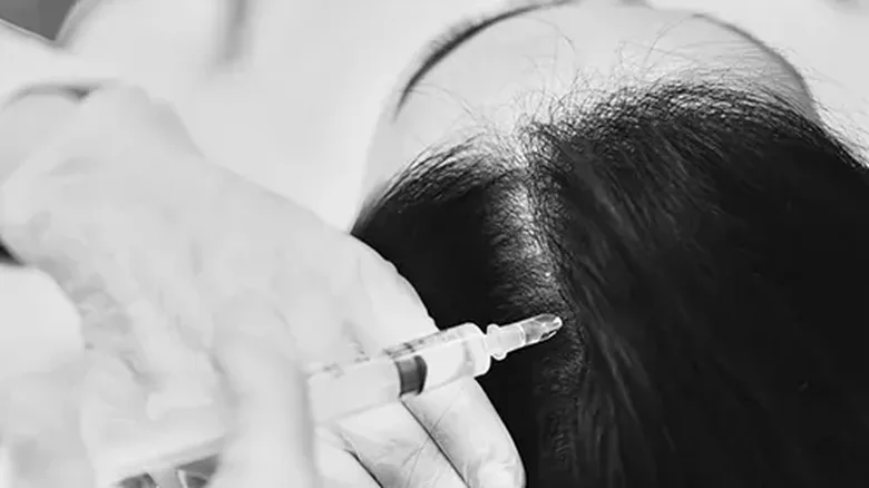 Tratamiento de mesoterapia capilar en el Medical Center de Spa Belgrano